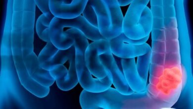 Colorectal Cancer Screening