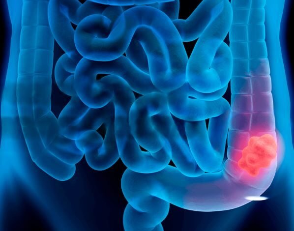 Colorectal Cancer Screening