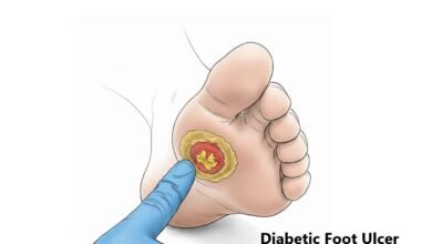 Diabetic Foot Ulcer